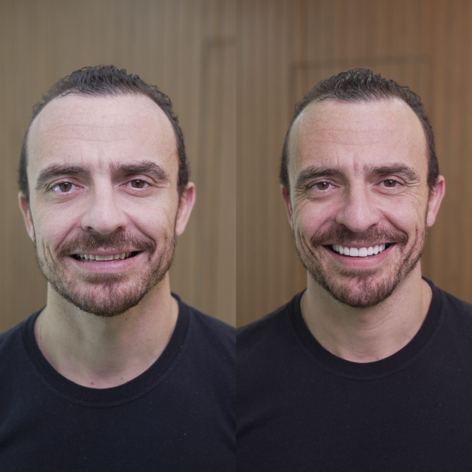 Lentes de Contato Dental