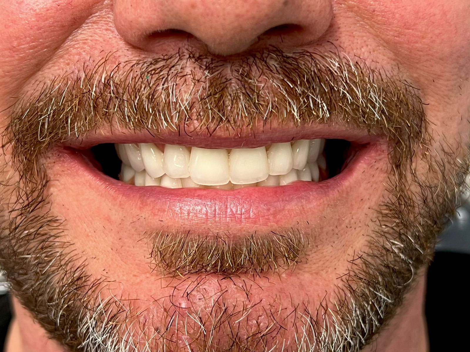 Implantes Dentários