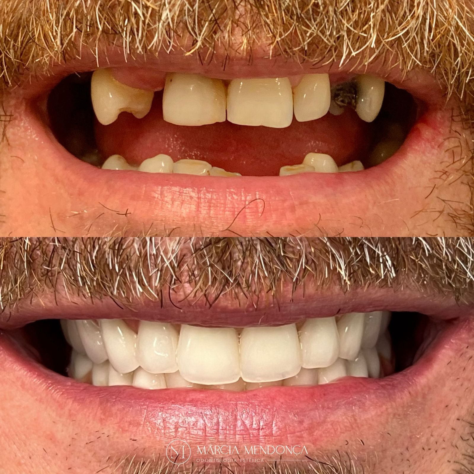 Próteses sobre Implante